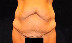 Manhattan abdominoplasty before 16